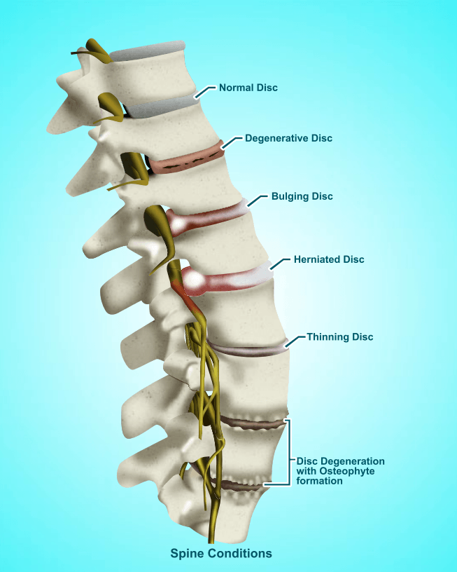 SPINAL DECOMPRESSION
