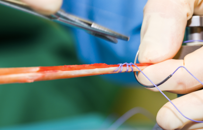 TENDON TRANSFER