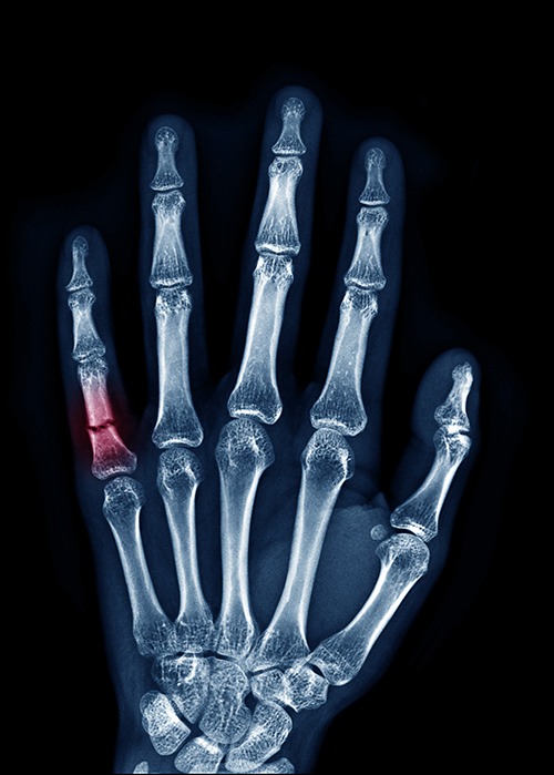 FINGER FRACTURE (PHALANX & METACARPAL) SURGERY
