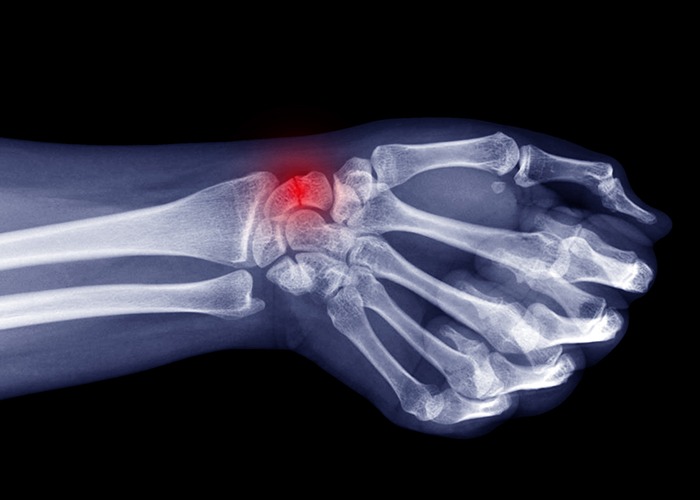 SCAPHOID FRACTURE AND NON-UNION REPAIR