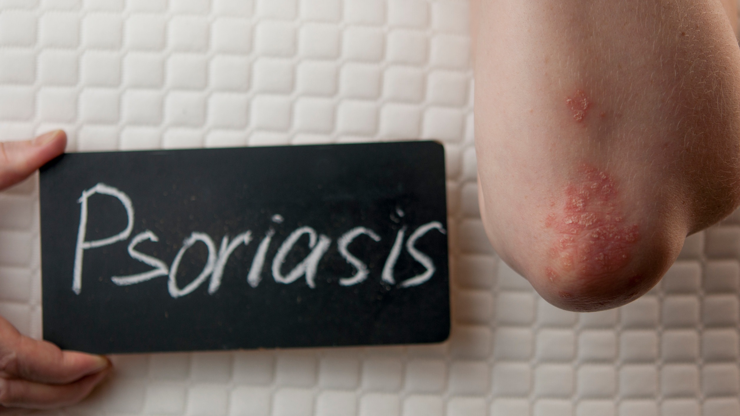 Psoriasis GLP-1 Therapy Benefits: Injection pen use