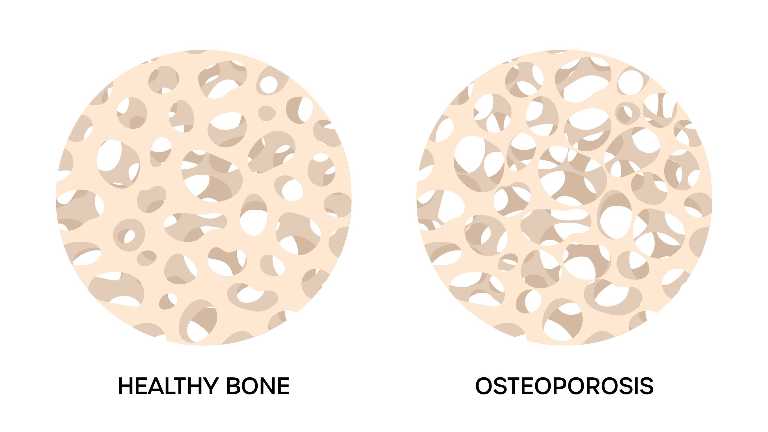 Medical scan report for BMD as Surrogate Osteoporosis Endpoint analysis.