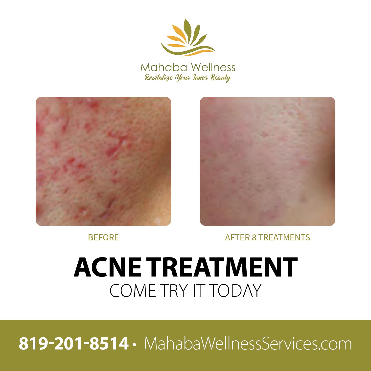 Mahaba Wellness Services - Acne treatment - Gatineau Quebec