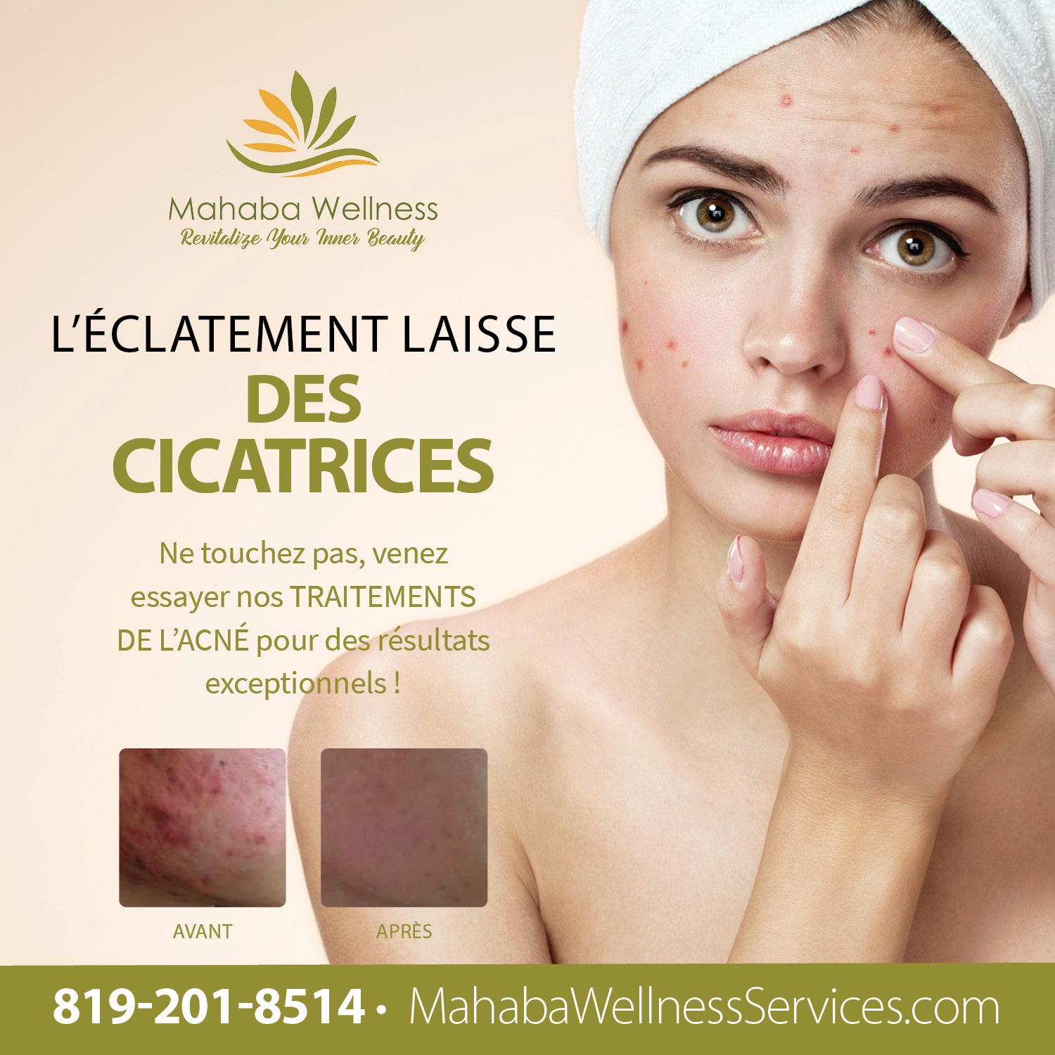 Mahaba Wellness Services - Traitement de l'acné - Gatineau Québec