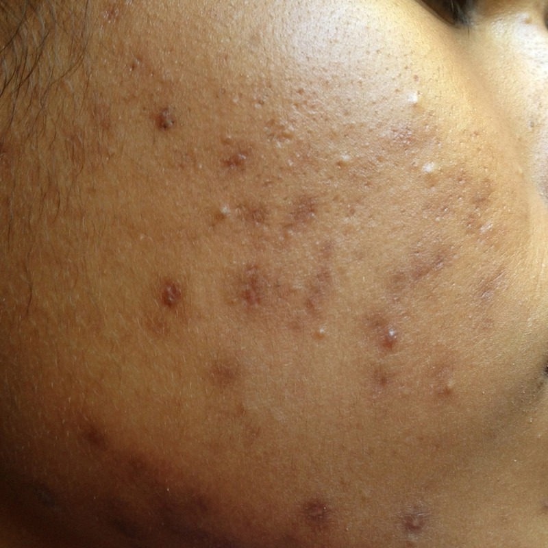 Clear skin laser before