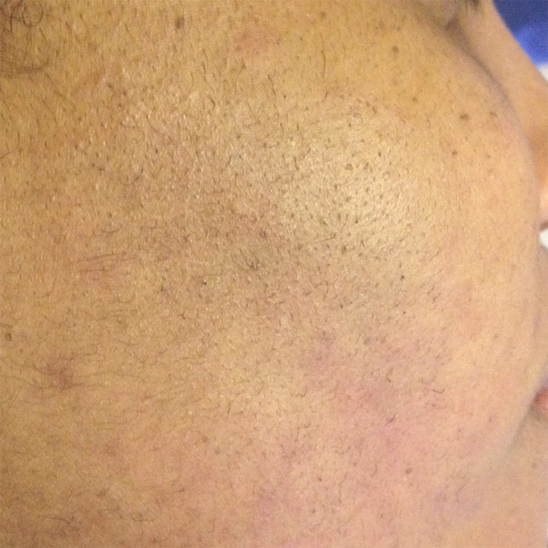 Clear skin laser after