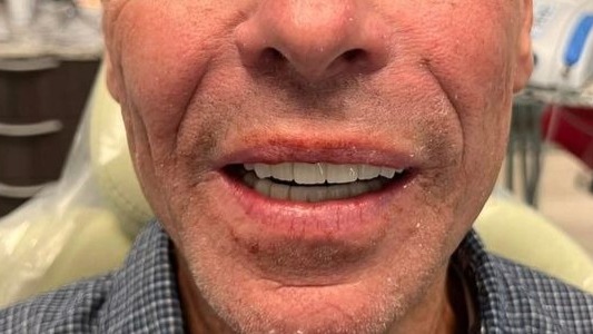 After Full Mouth All-on-1 Mono Dental Implants