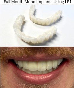 Full Arch Upper and Lower LP1 Mono Implant Case