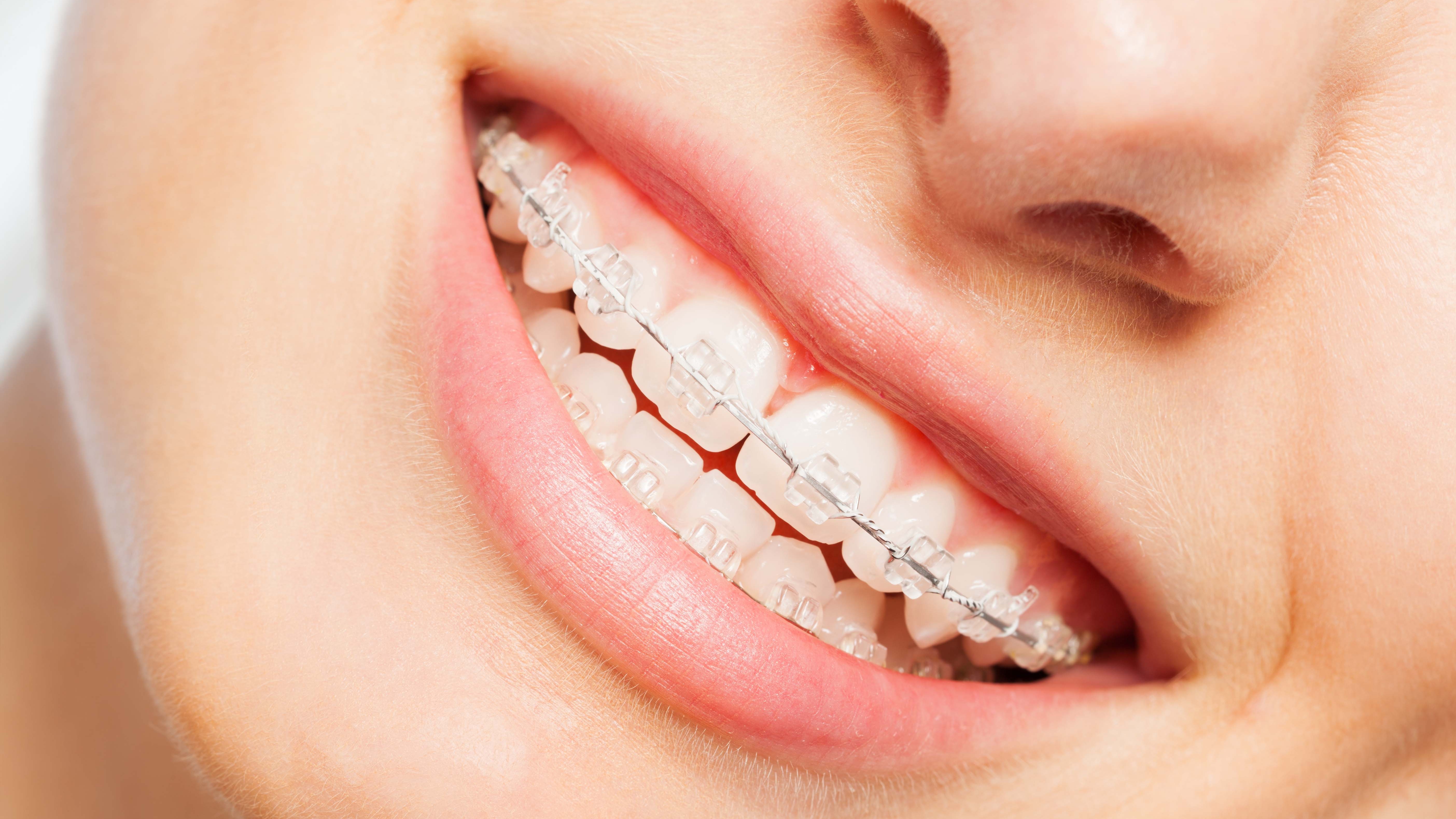Clear Braces