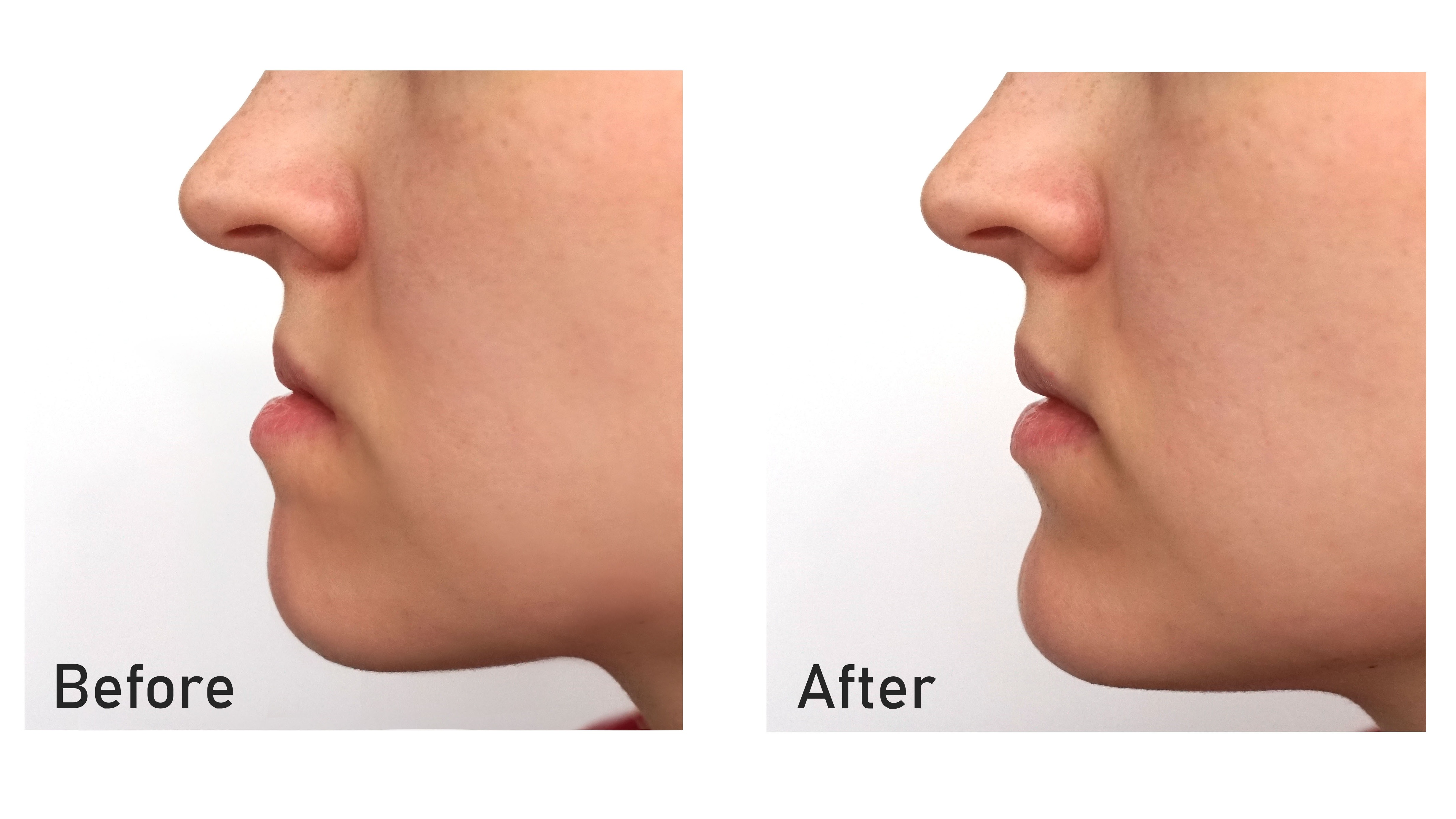 Surgical Orthodontics
