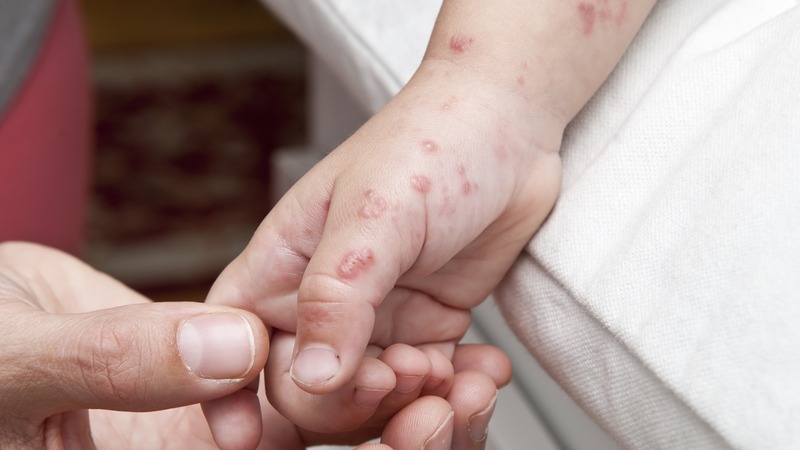 a hand full of herpes blisters