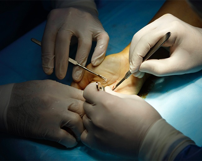 DUPUYTREN’S CONTRACTURE