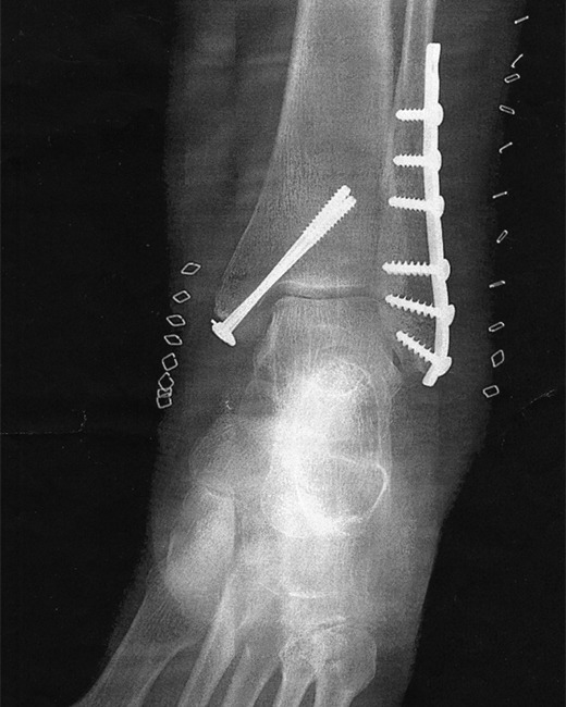 LOWER EXTREMITY TRAUMA