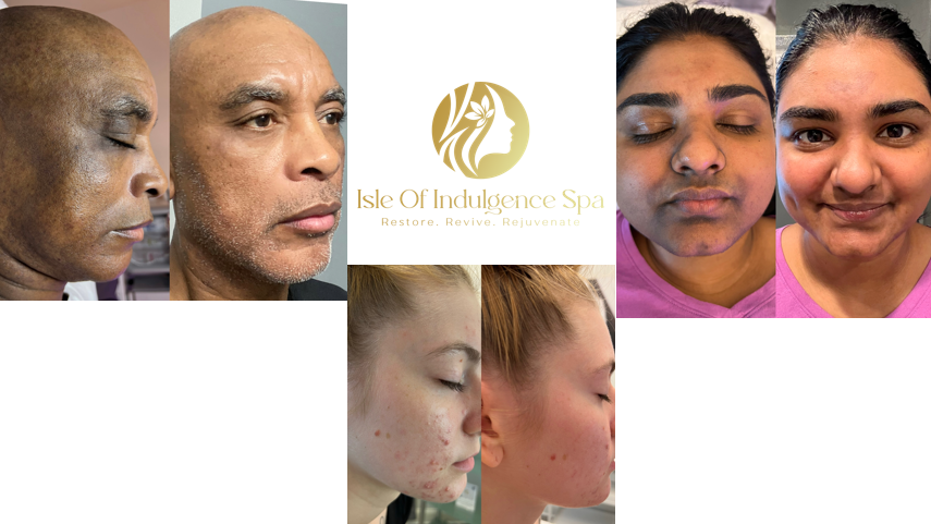 Images of people after using the VI Peel