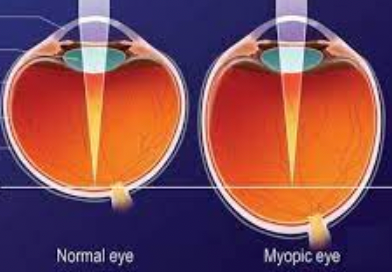 normal eye compared to myopic eye