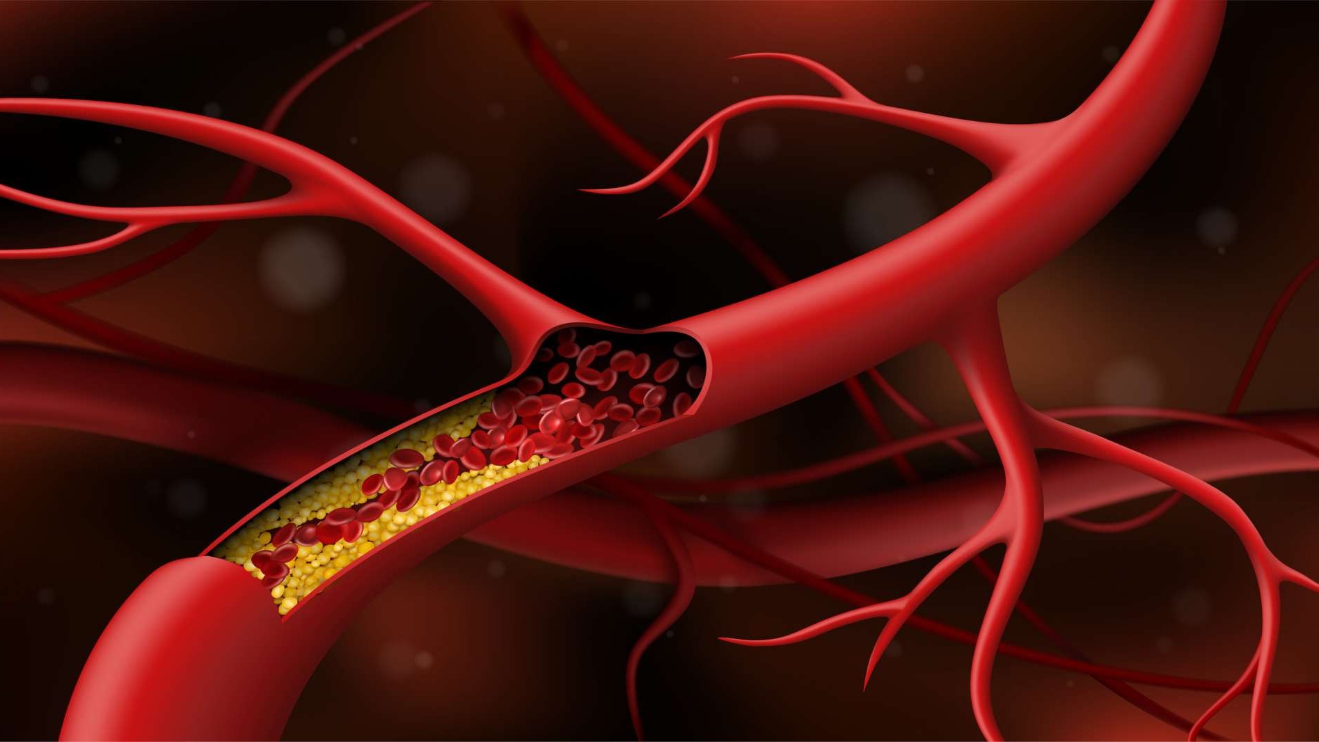  vascular disease-artery blocked by cholesterol