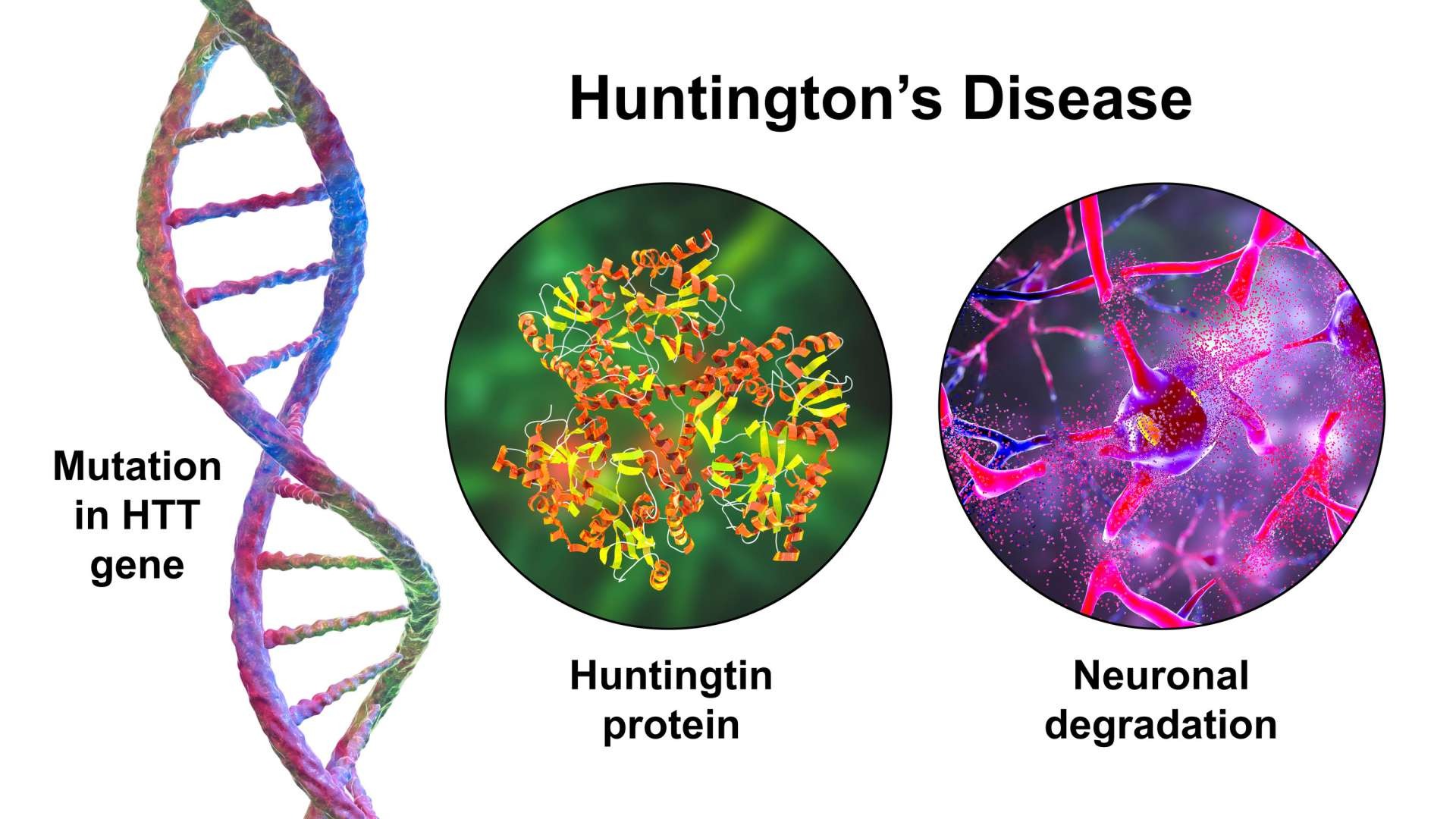 Illustration of Huntington's disease 