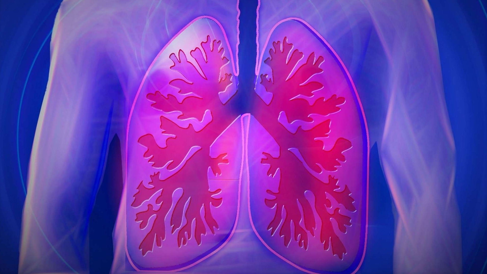 High-resolution CT scan illustrating cystic fibrosis effects on lungs, highlighting CFTR modulators.