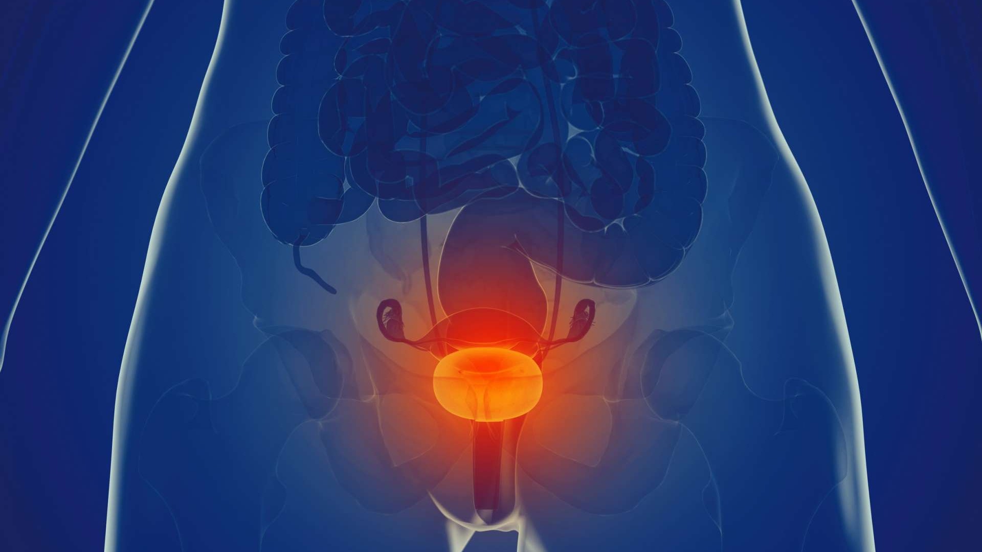 Anatomical illustration showing bladder with tumor for Immune Checkpoint Inhibitors in NMIBC.
