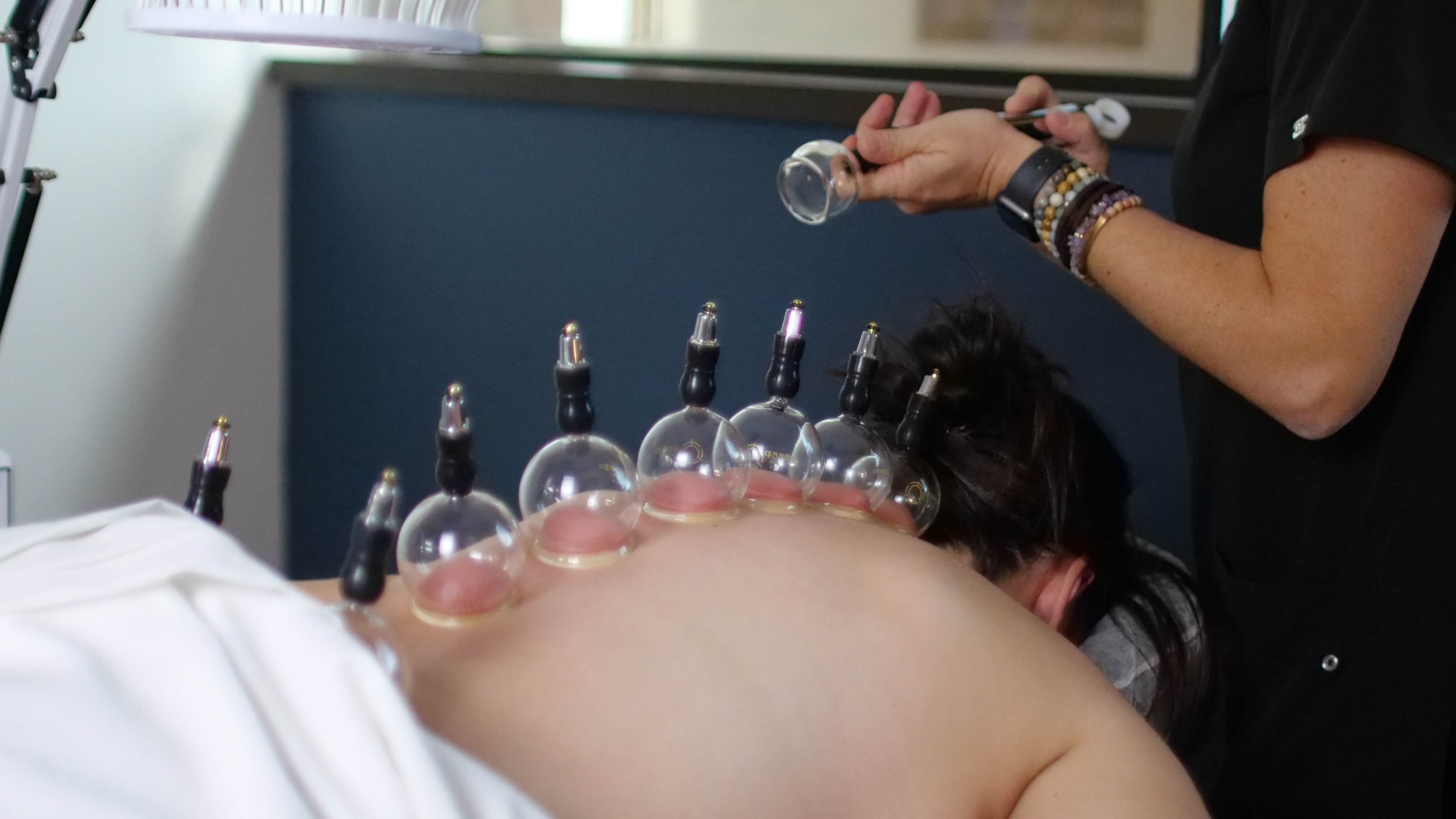 Woman getting Cupping Therapy which can be used along with acupuncture