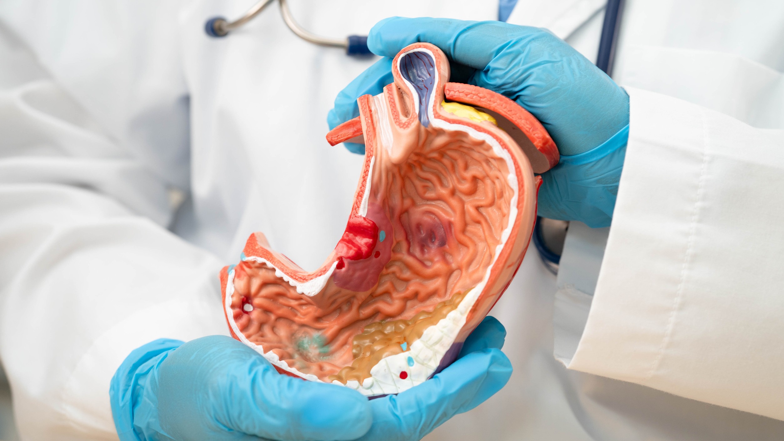 Illustration of gastric area showing tumor for gastric cancer prevention.
