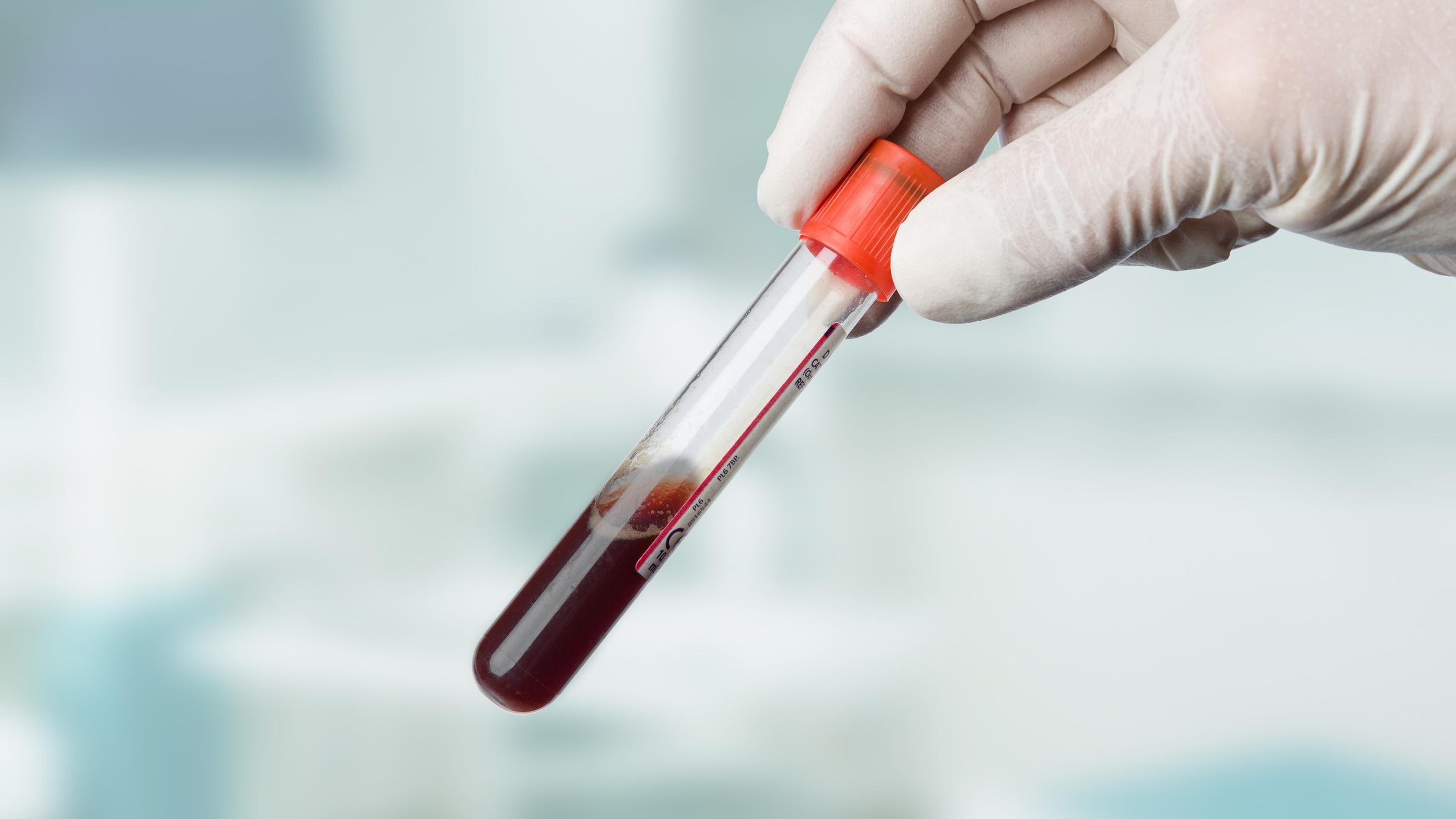 Closeup of blood in test tube for Alzheimer's diagnosis testing in a lab.