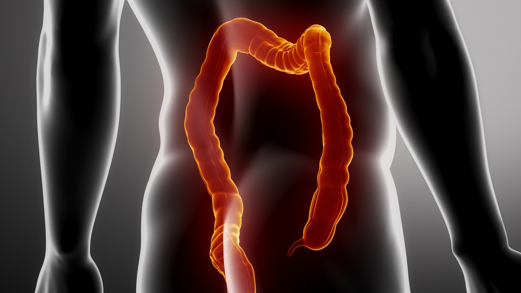 3D illustration of rare appendix cancer in millennials.