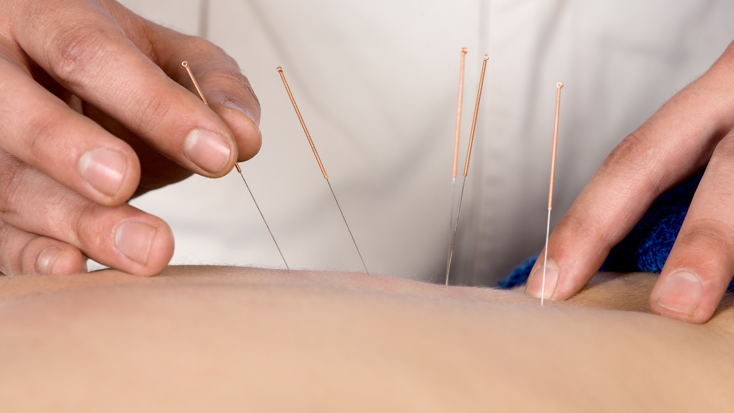 Acupuncture session for easing chronic low back pain.