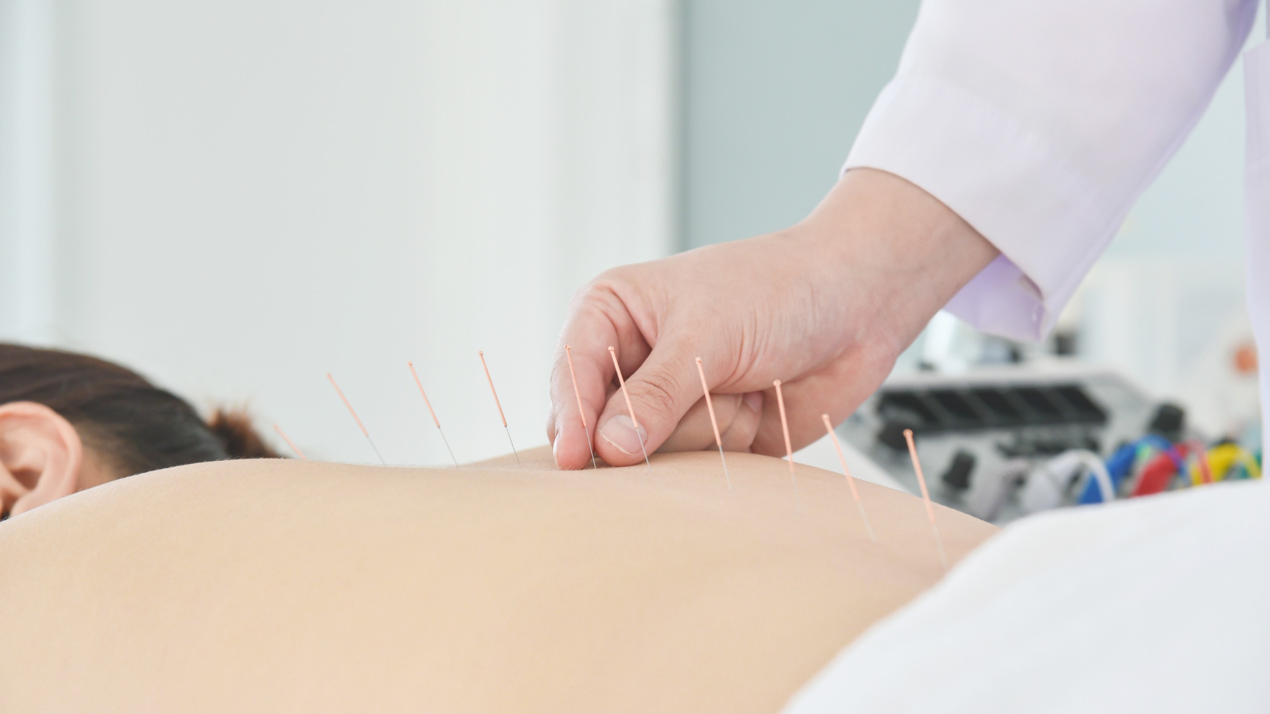 Acupuncture needles in back for chronic pain relief in seniors.