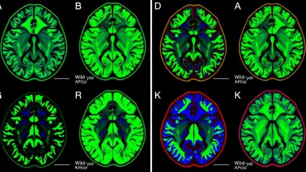 Fluorescent brain slices showing Shank3-related autism treatment pathway data.