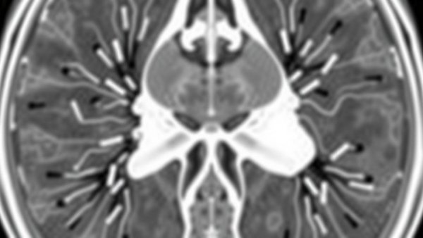 New prostate biopsy technique shows potential future of MRI