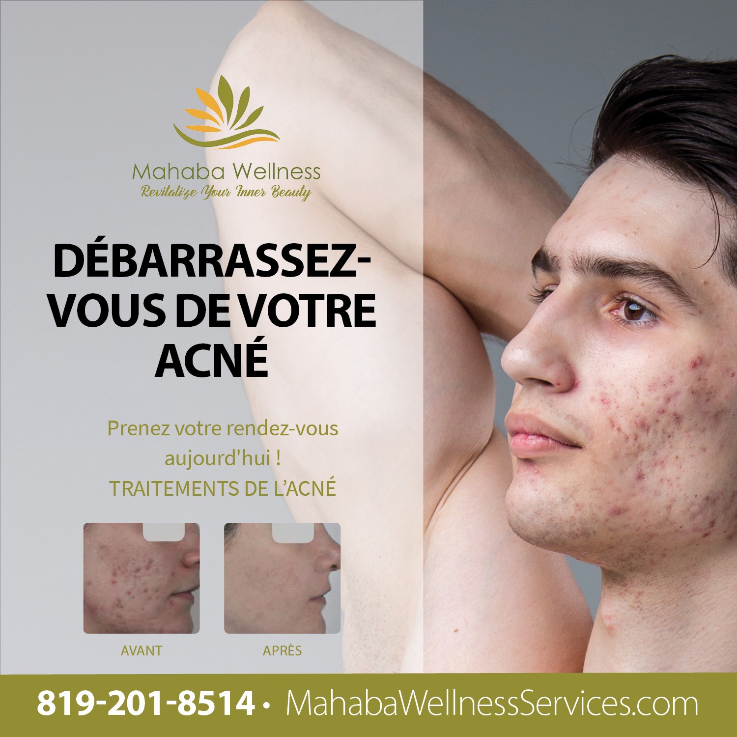 Mahaba Wellness Services - Traitement de l'acné pour les hommes - Gatineau Québec
