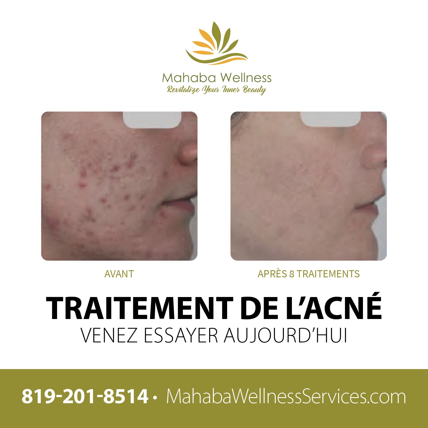 Mahaba Wellness Services - Traitement de l'acné - Avant après