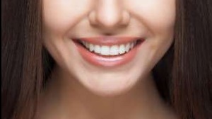 Dental Veneers