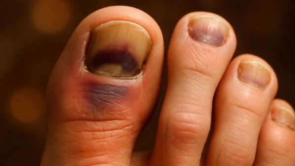 Relieve toenail pain from shoes with a close-up of sore toes.