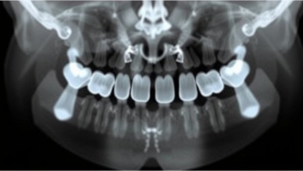 Effect of Early Radiographic Bone Loss Before Loading on Implant‐Related Outcomes: A Long‐Term Retrospective Study