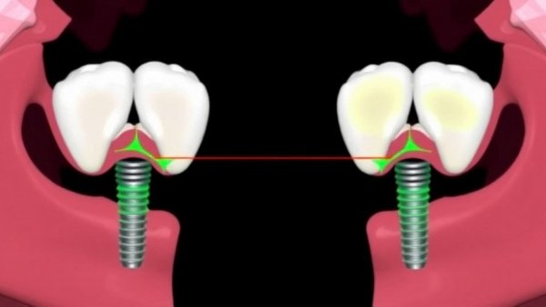 Trueness of Dental Implant Placement Using Dynamic Navigation or Non‐Guided Approach by Novice Surgeons: A Randomized, Controlled Clinical Trial