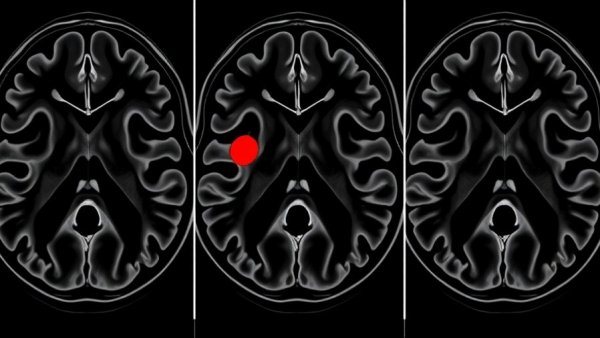 MRI in Active Surveillance for Prostate Cancer: detailed scans with highlighted regions.