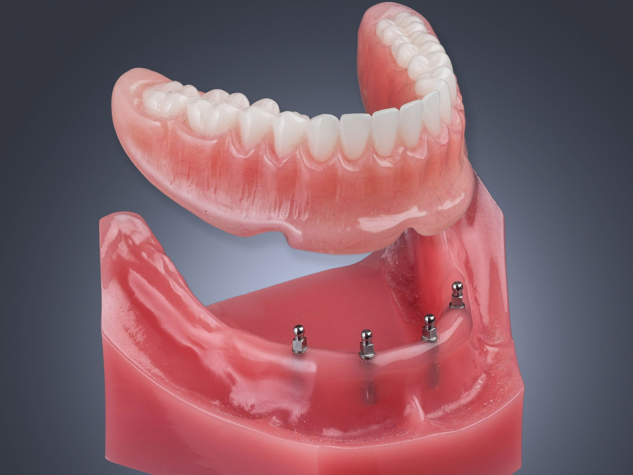Mini Dental Implants