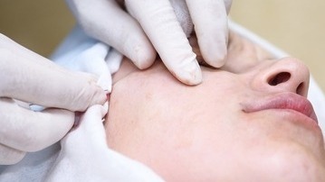Scar Removal for Beautiful Skin