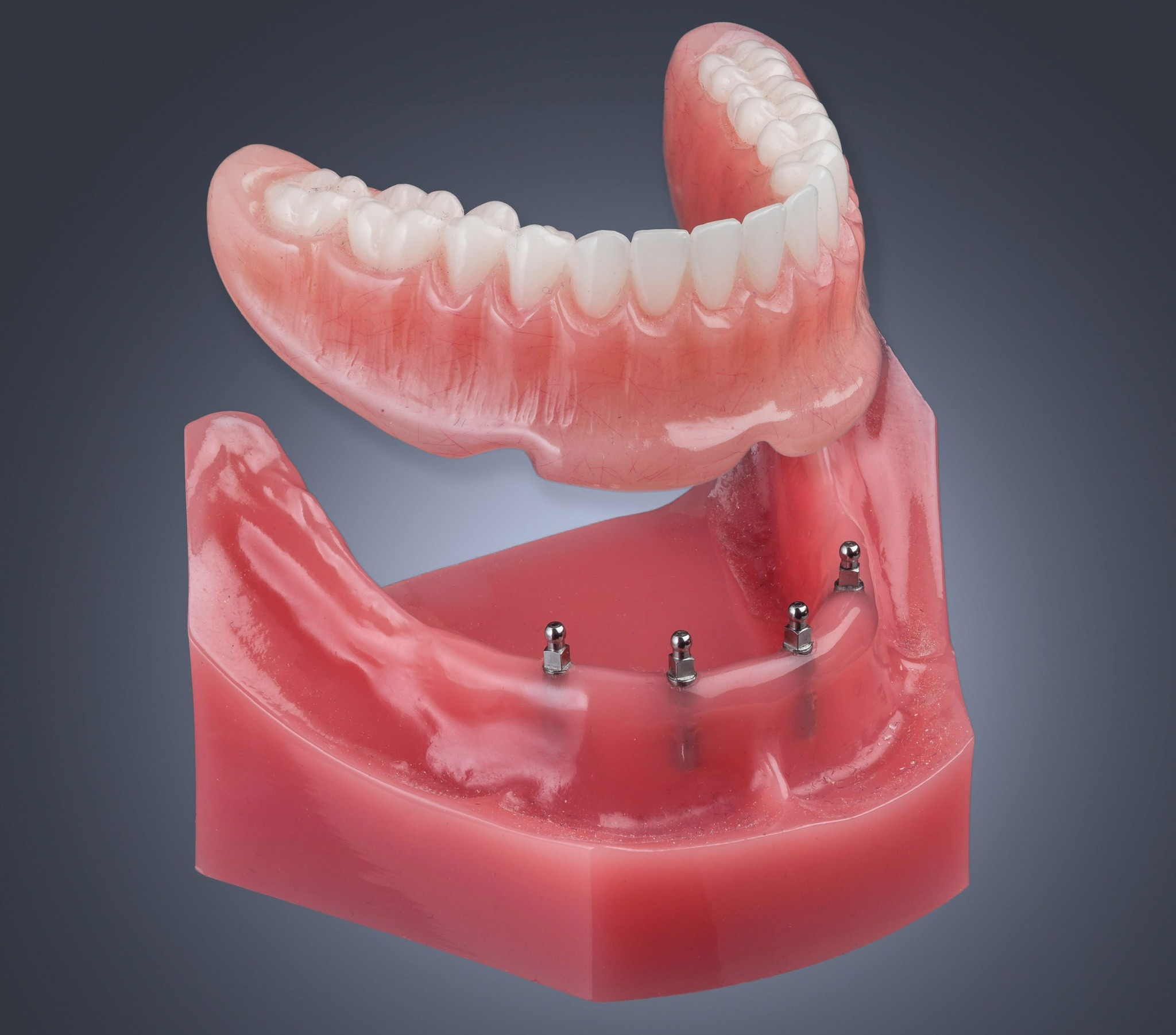 Mini Dental Implants for Denture Stabilization