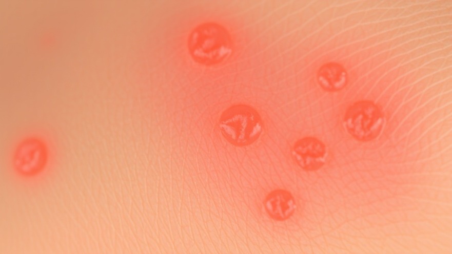 Unveiling Geniculate Herpes Zoster: Key Insights for Wellness-Oriented Practices
