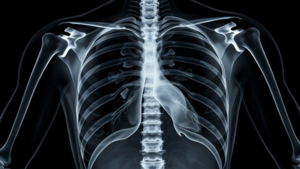X-ray of human chest for AI tuberculosis screenings.