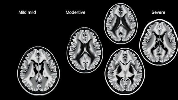MRI scans showing cerebral small vessel disease progression.