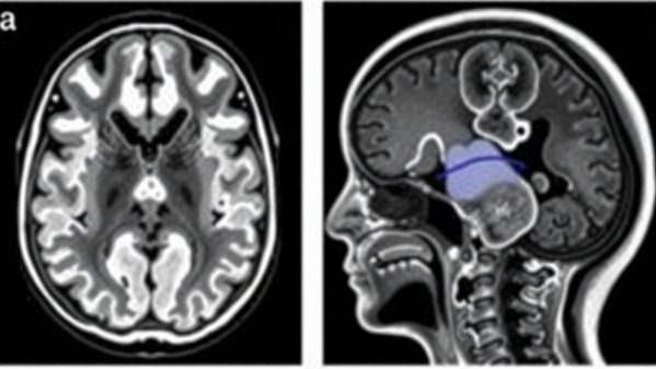 Unlocking Vital Knowledge on Congenital Brain and Spine Malformations