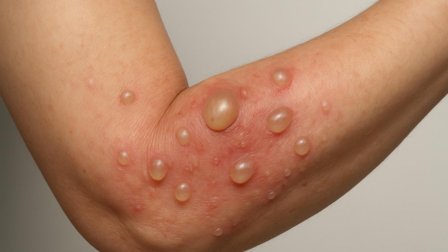 Exploring Bullous Pemphigoid: Insights for Concierge Medical Practitioners