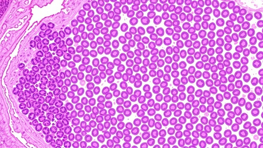 Revolutionary AI Tool Distinguishes Ewing Sarcoma with 91.6% Accuracy