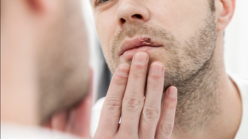 Man with blisters on lip looking in the mirror