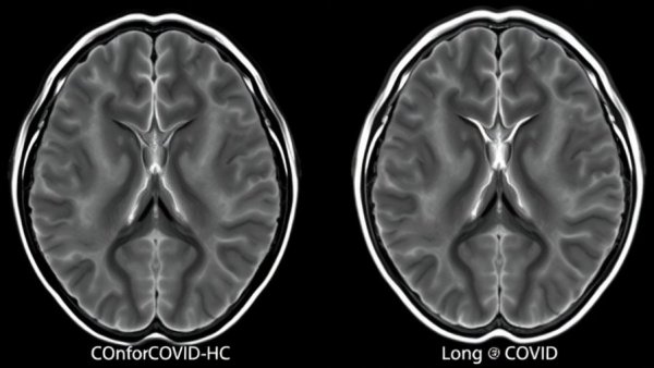 MRI brain scan comparing COVID-19 impacts on health.